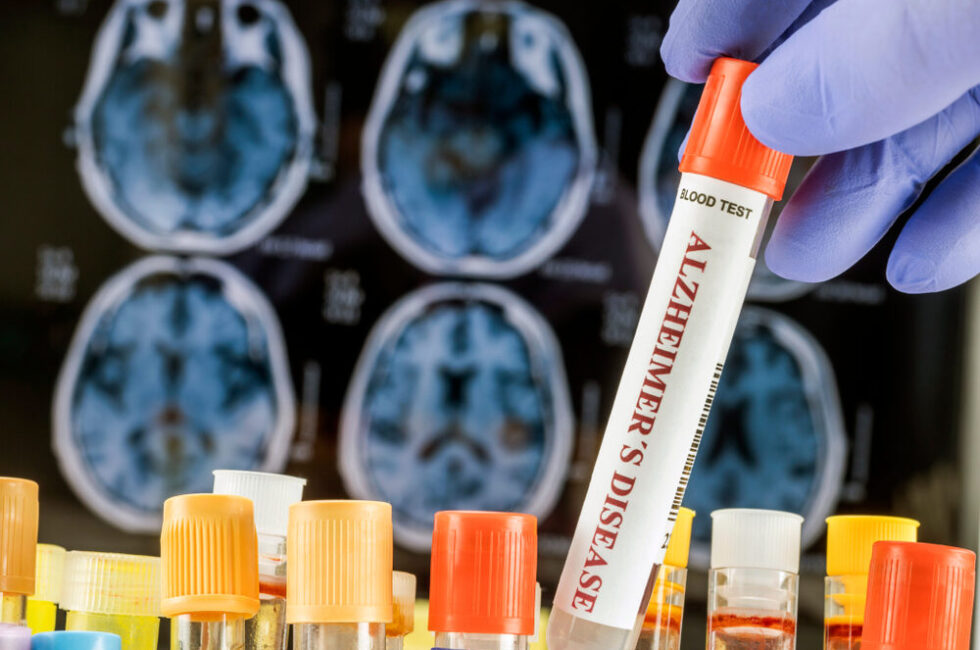 Organoidi cerebrali per la ricerca sull'Alzheimer